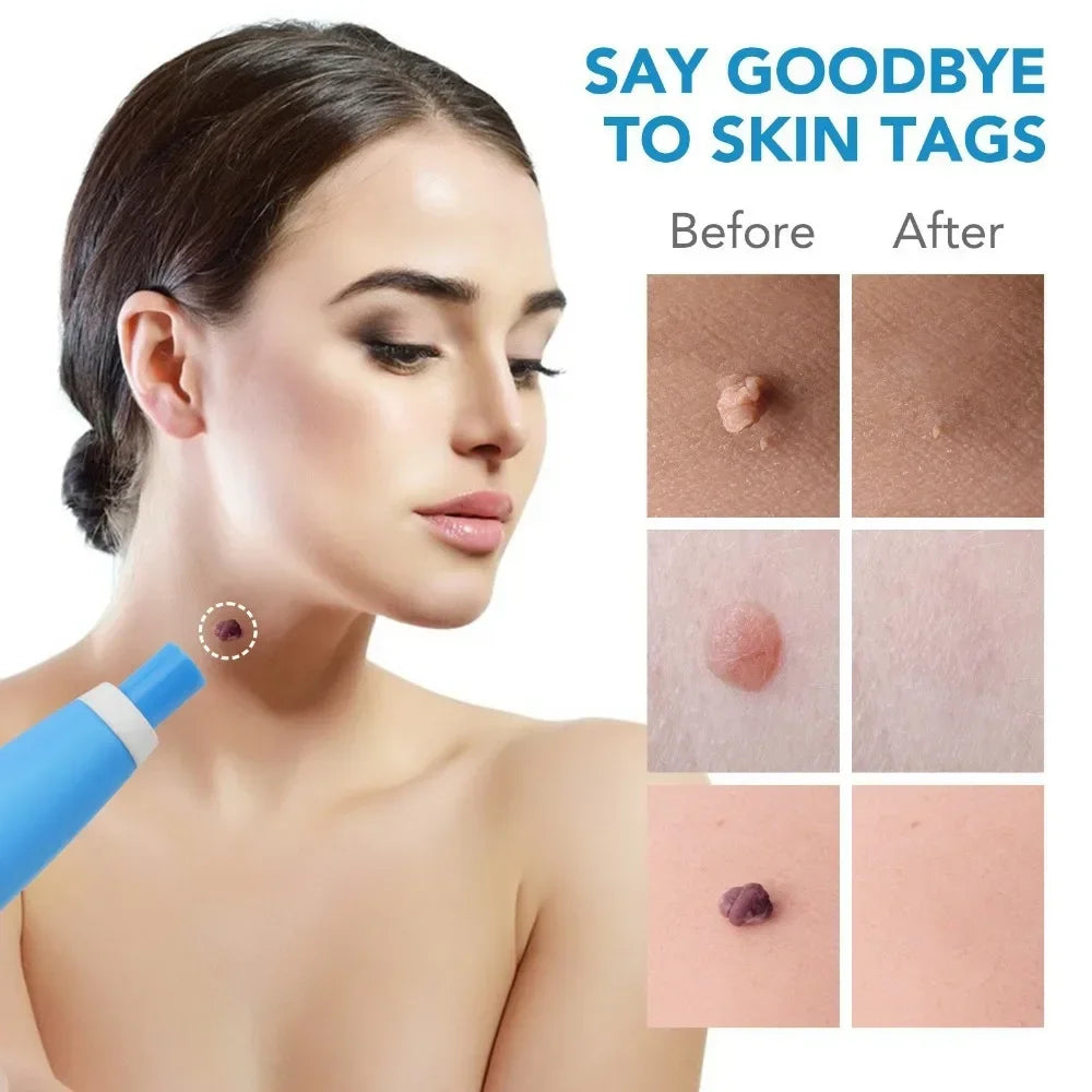 Painless Skin Tag Remover Pen