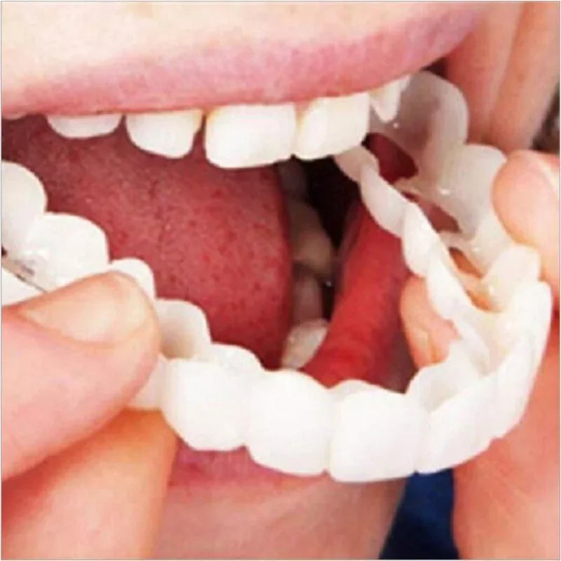 Snap On Smile Veneers
