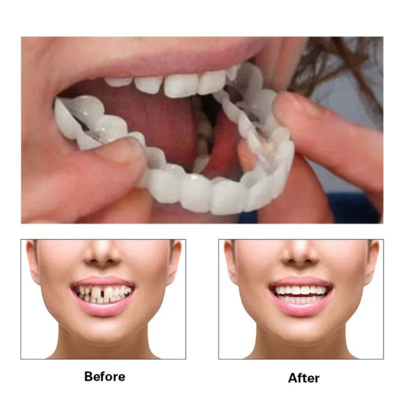 Snap On Smile Veneers